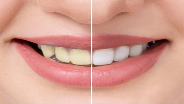 How to keep teeth white? Learn the home method