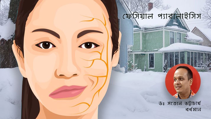 The defeat of facial paralysis behind the winter amazement of Poush